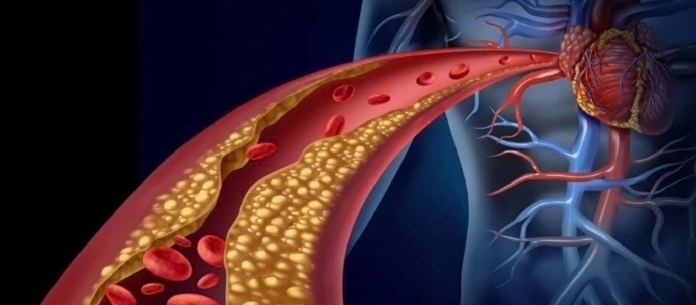 Στεφανιαία νόσος: Δείτε ποιοι κινδυνεύουν λιγότερο